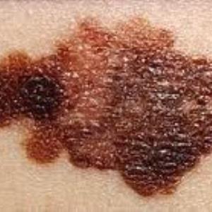 Melanoma Skin Cancer